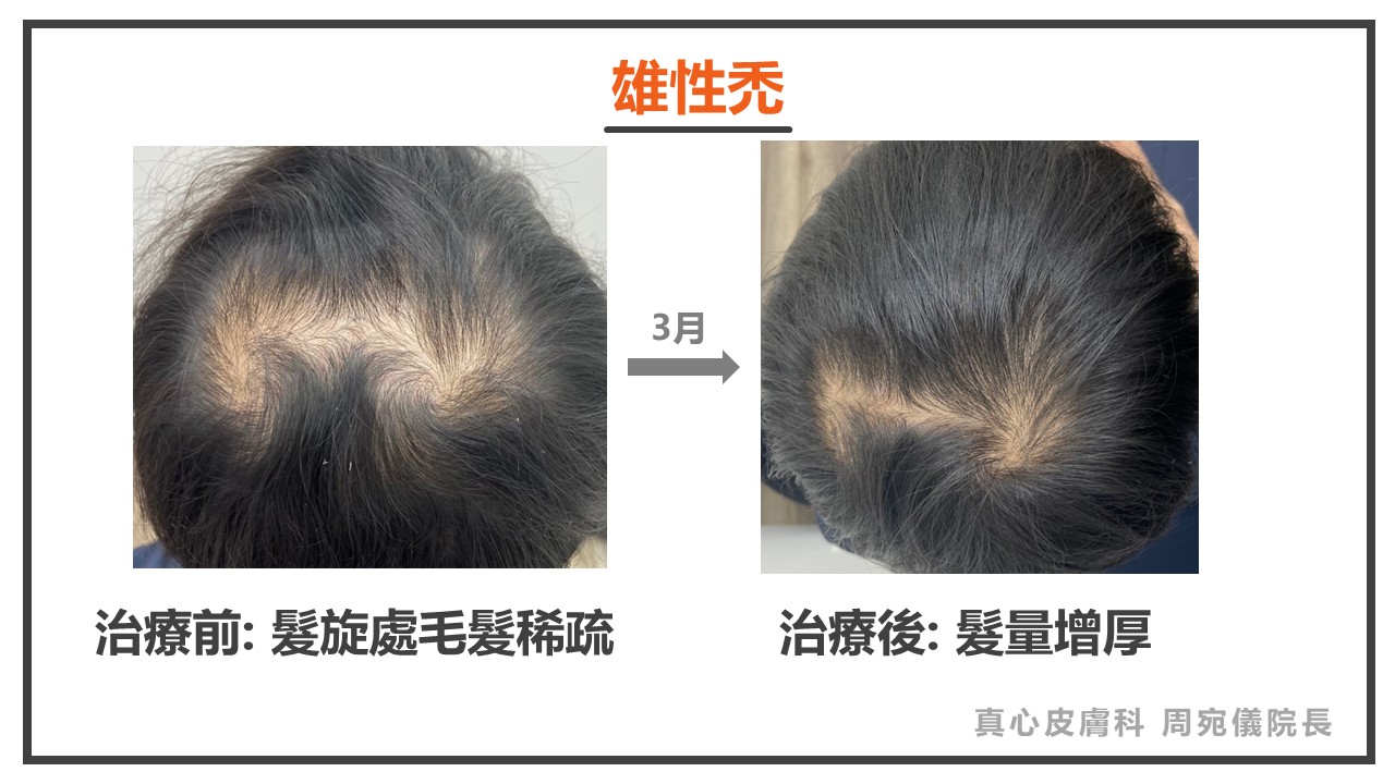 落髮怎麼辦