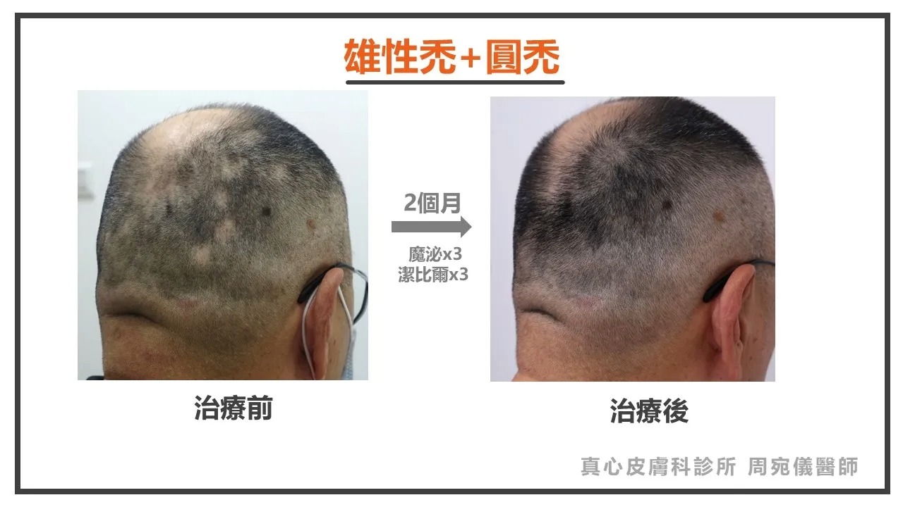 雄性禿