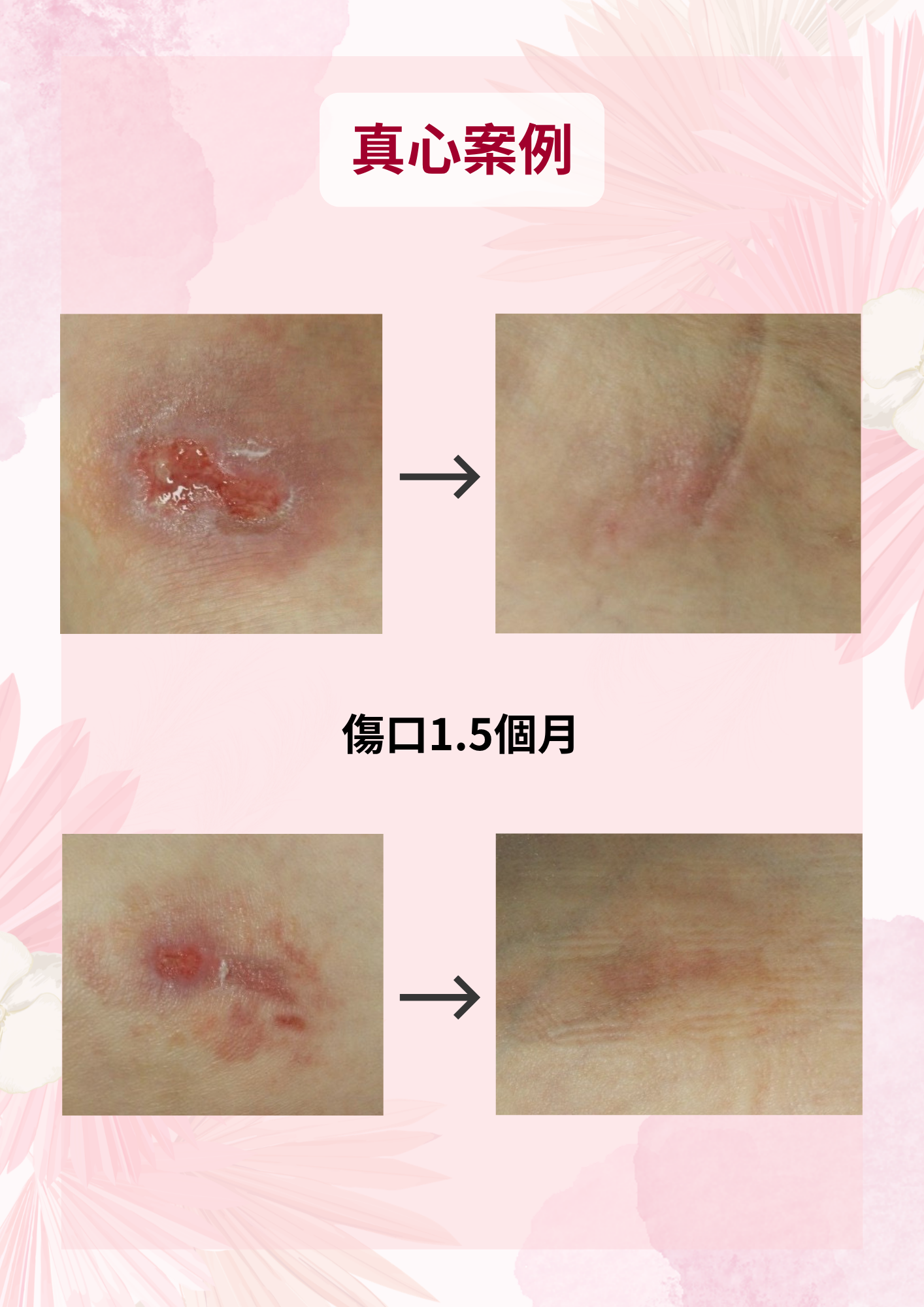 粒線體雷射