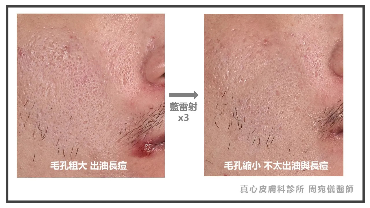 藍雷射效果