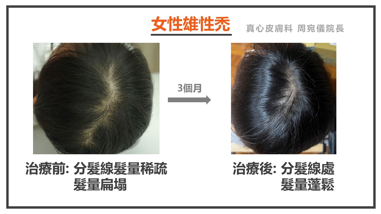 女性雄性禿
