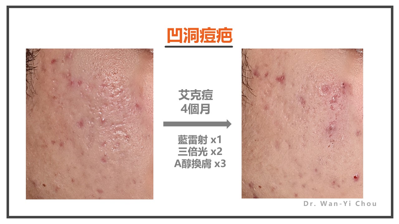 凹洞痘疤