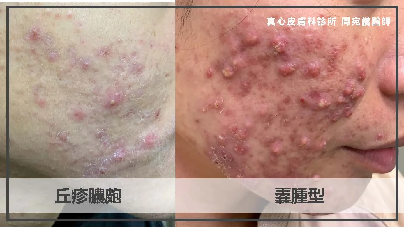 丘疹膿皰