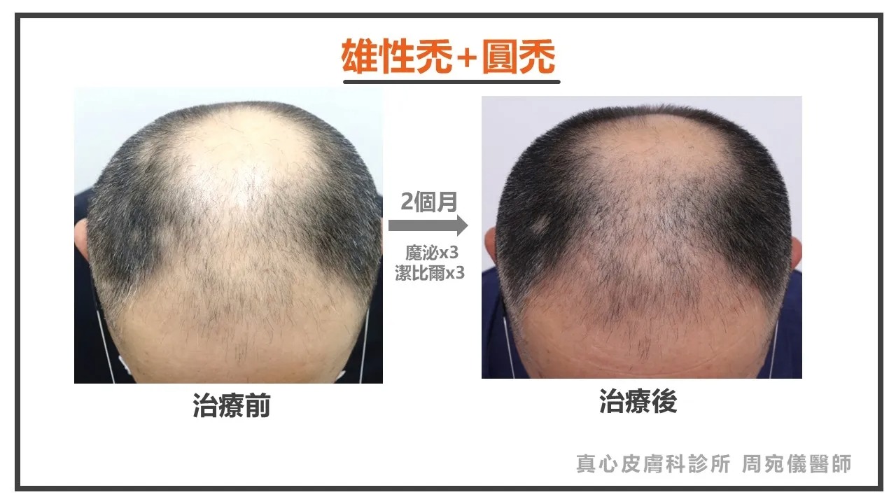 雄性禿
