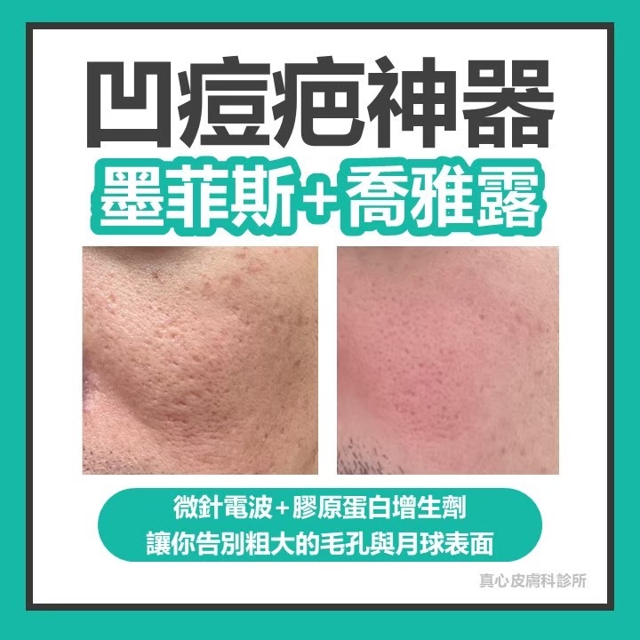 凹疤治療