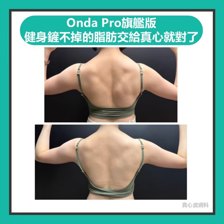 瘦背