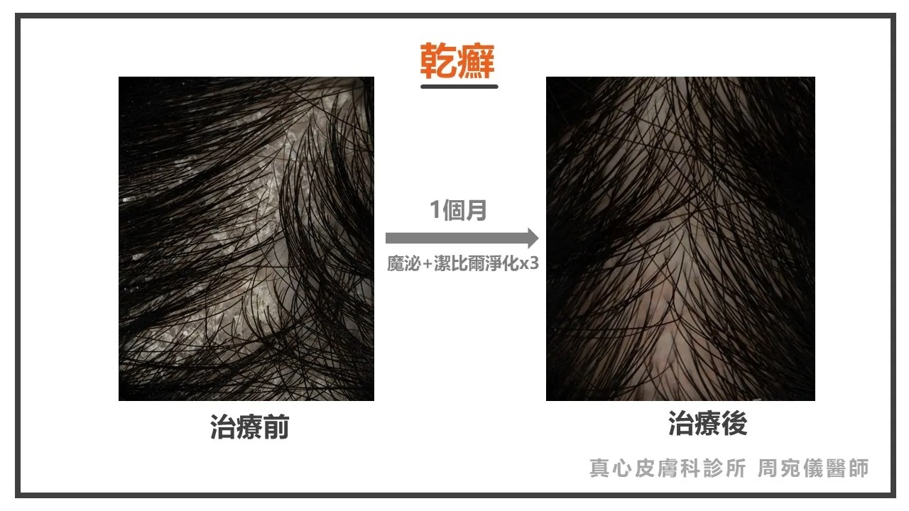 頭皮 乾癬