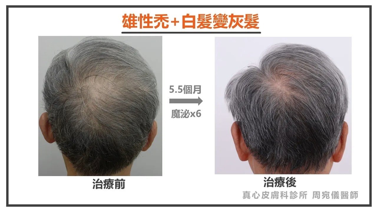 雄性禿
