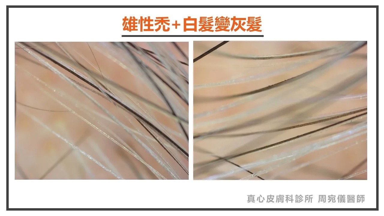 雄性禿 白髮回灰髮