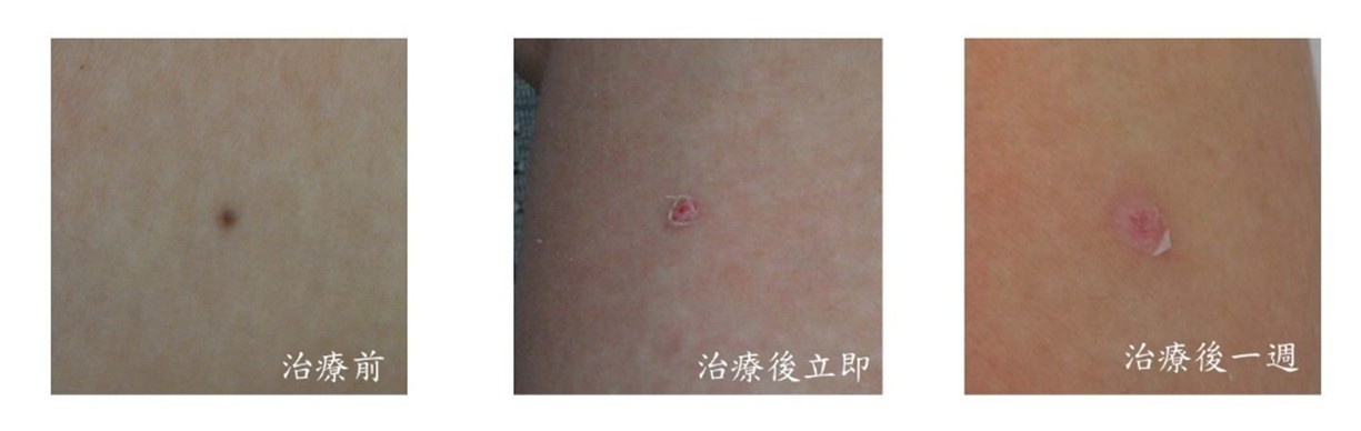 除痣