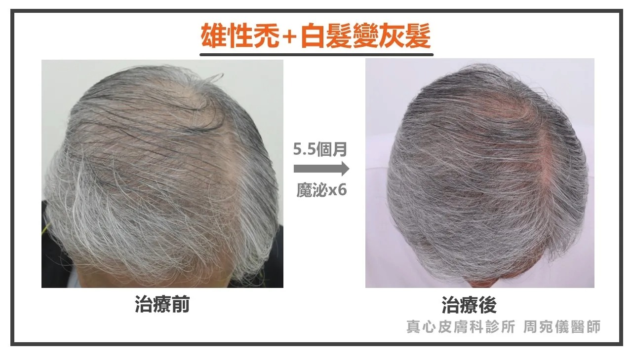 雄性禿