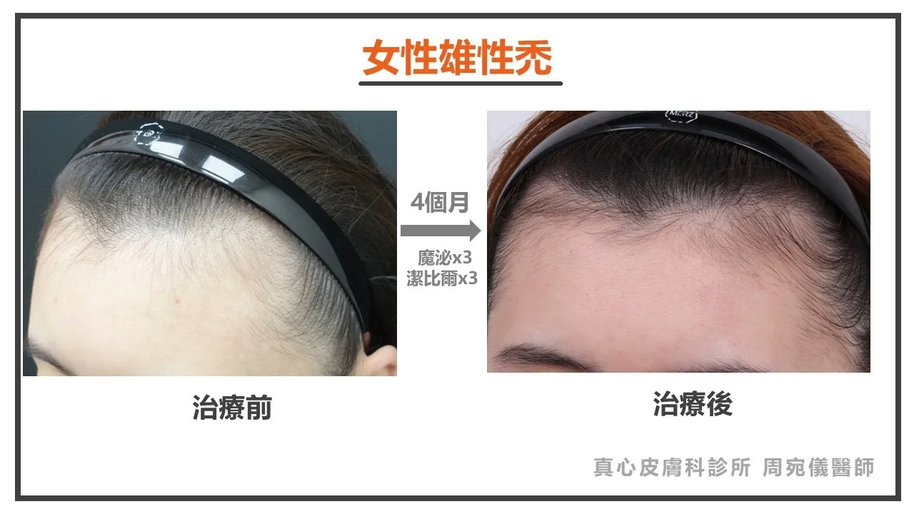 女性雄性禿