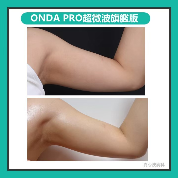 瘦蝴蝶袖