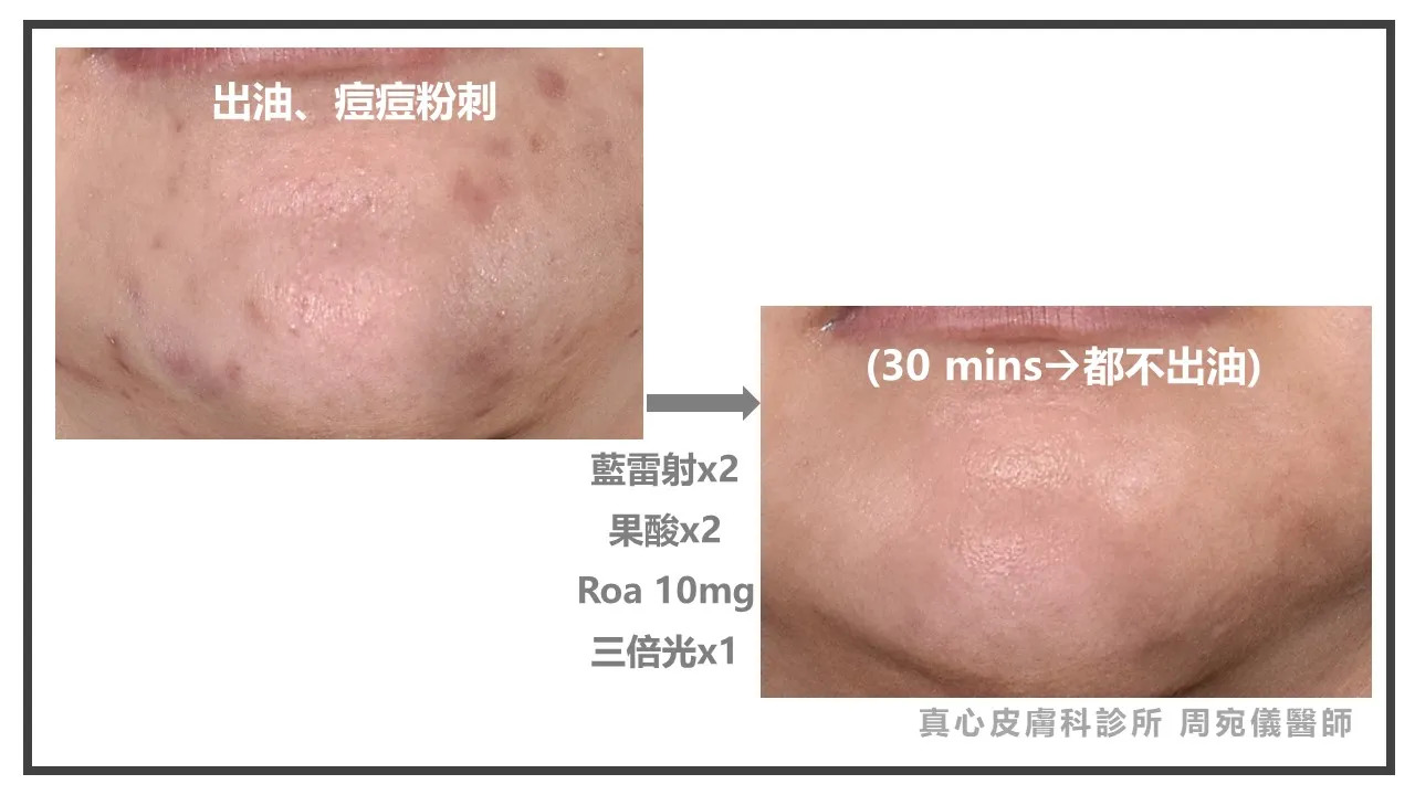 藍雷射效果