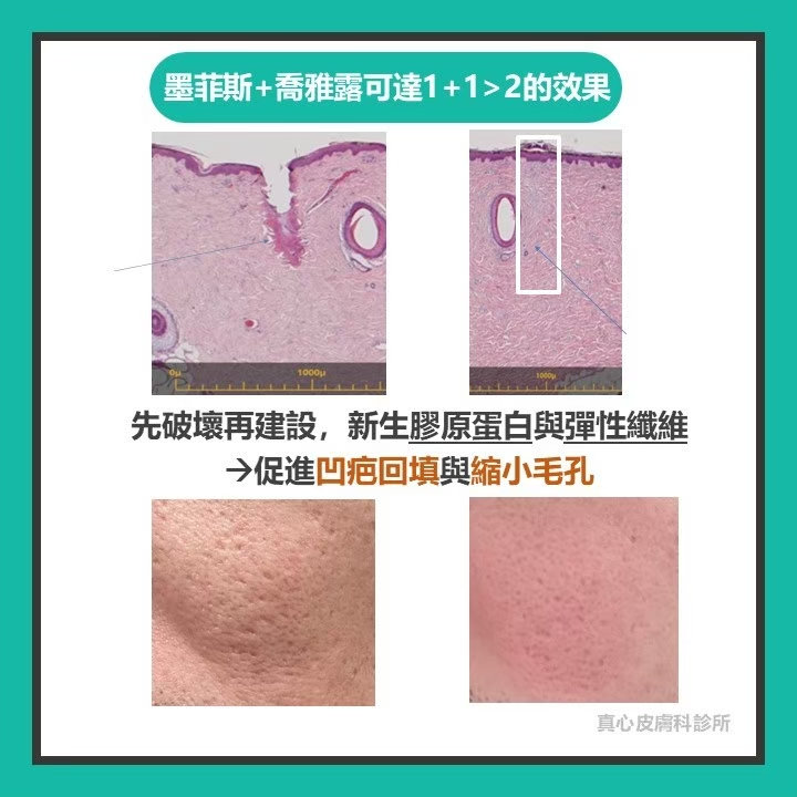 凹疤