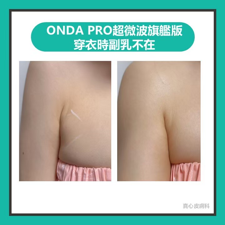 瘦副乳
