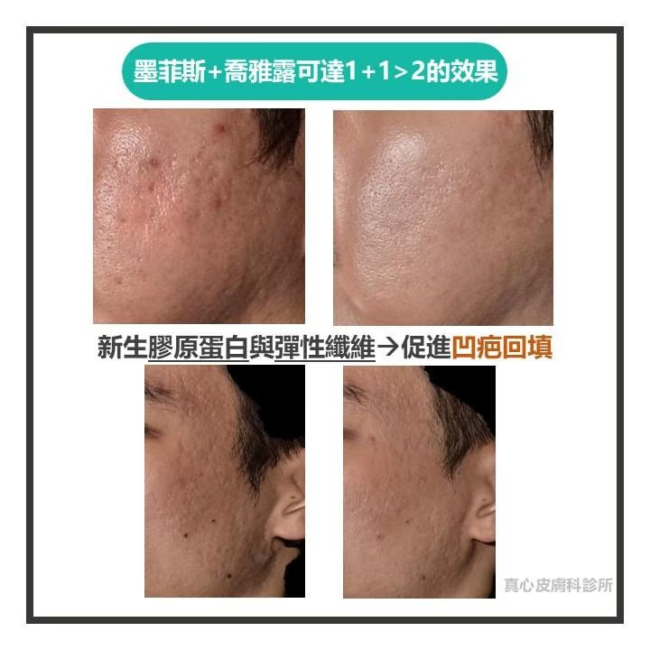 凹疤喬雅露
