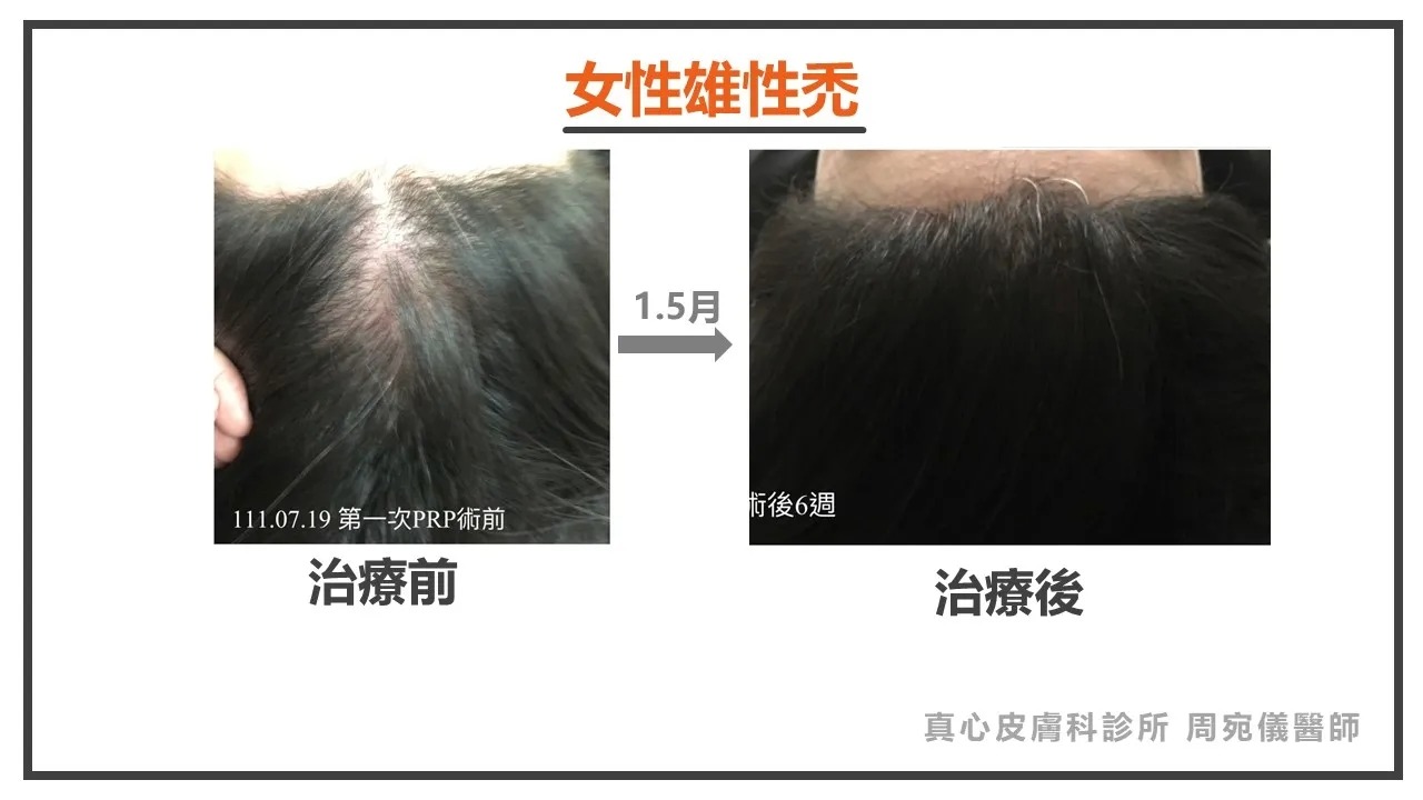 女性雄性禿