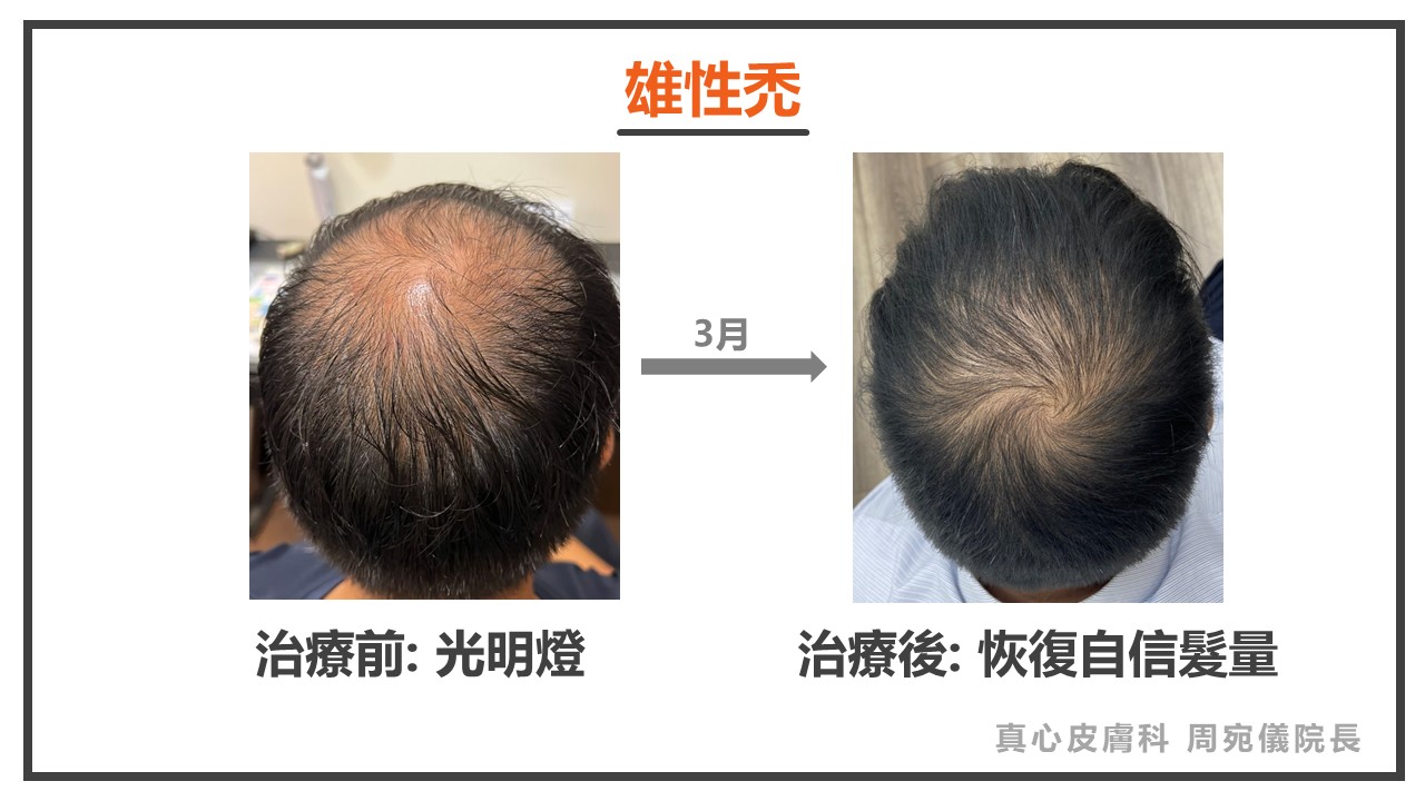 落髮怎麼辦
